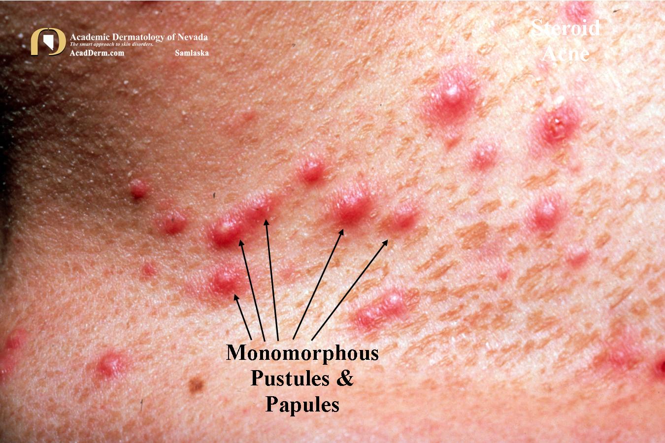 AcneMedica4Samlaska Academic Dermatology of Nevada