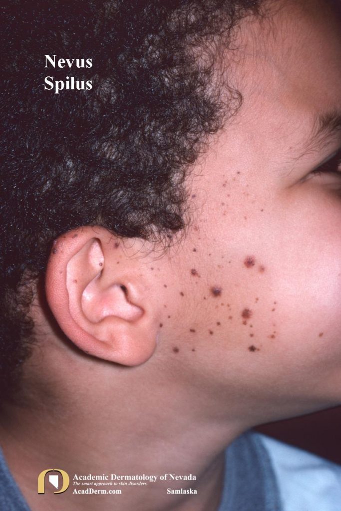 Nevus Spilus Speckled Lentiginous Nevus... Academic Dermatology of