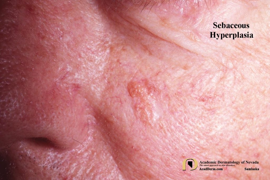 Sebaceous Hyperplasia Nose