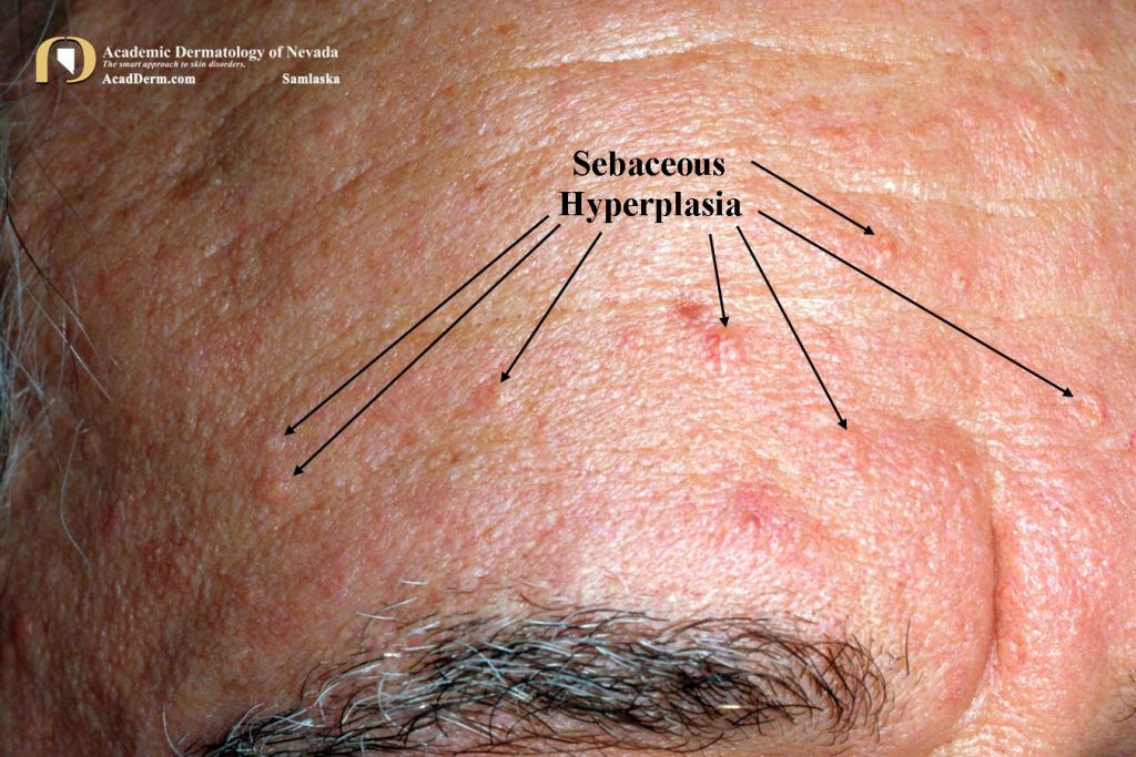 Sebaceous Hyperplasia Nose