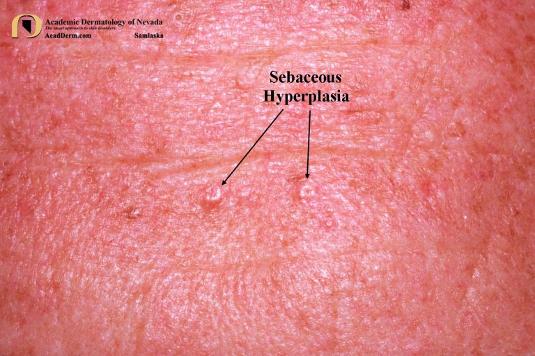 Sebaceous Hyperplasia Tiny Yellow Donuts... Academic Dermatology of