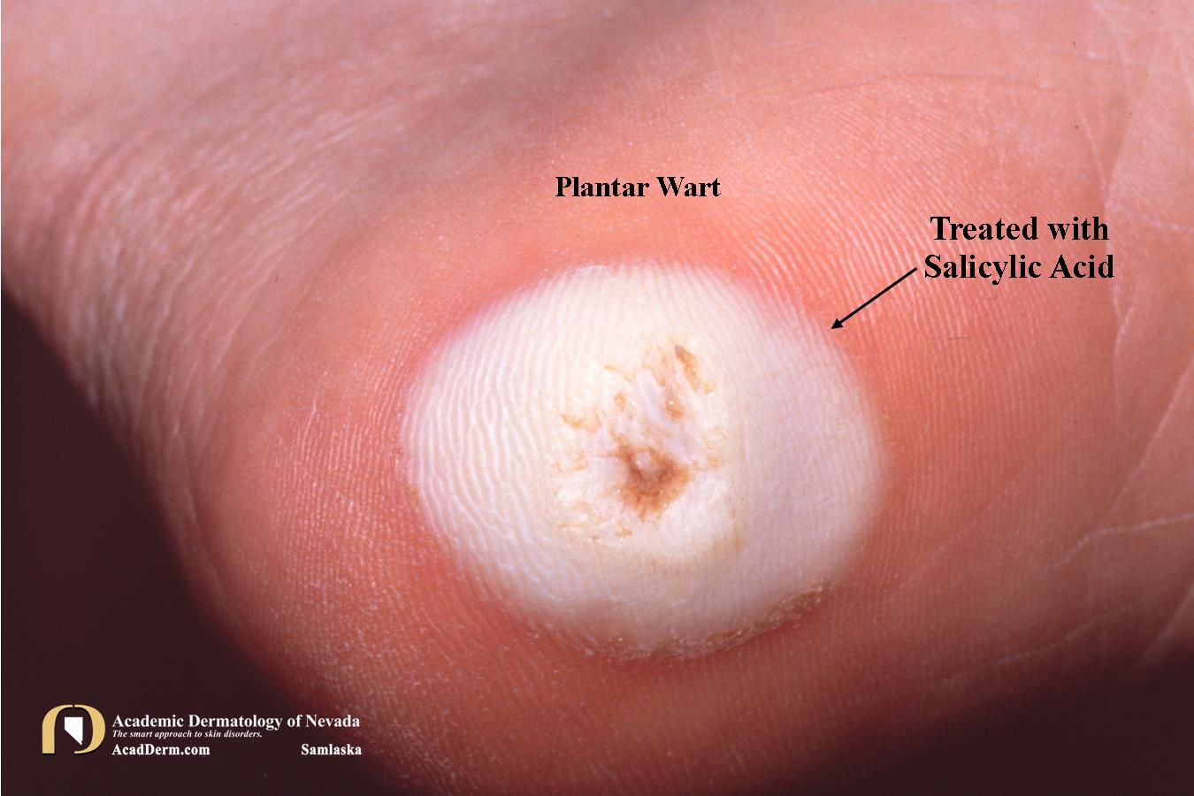 Plantar Warts (Verruca Plantaris) Seed Warts? Academic Dermatology of Nevada