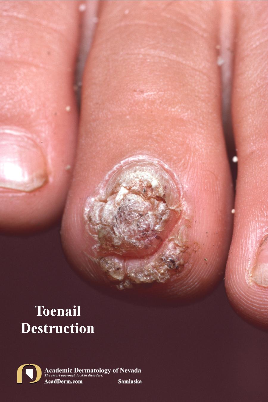 Plantar Warts (Verruca Plantaris) Seed Warts? Academic Dermatology of Nevada