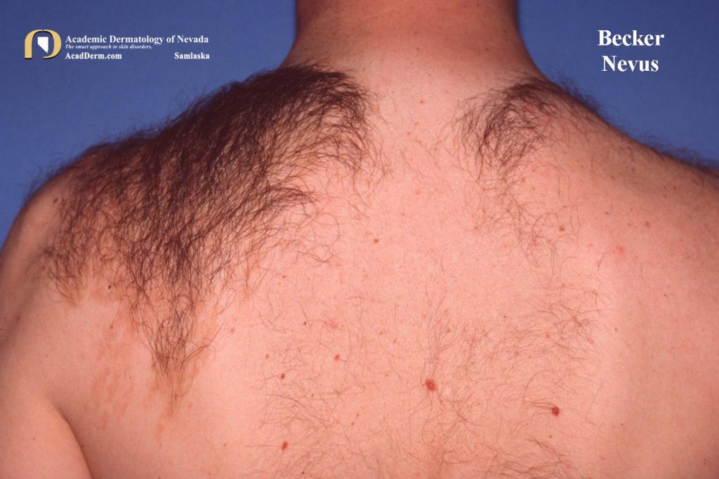 Becker Nevus A Manly Thing... Academic Dermatology of Nevada