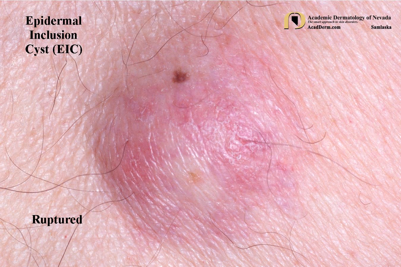 Epidermal Inclusion Cysts (EIC) Epidermoid Cysts... Academic Dermatology of Nevada