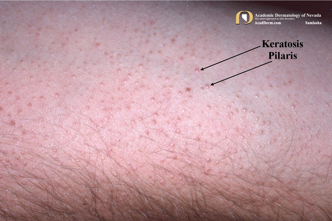 Keratosis Pilaris It Feels Like Sandpaper... Academic Dermatology of