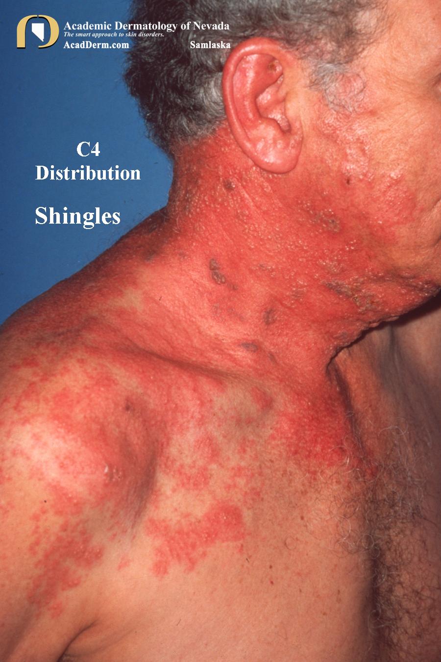 Shingles On Neck