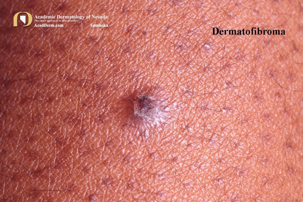 Dermatofibroma Benign Fibrous Histiocytoma... Academic Dermatology
