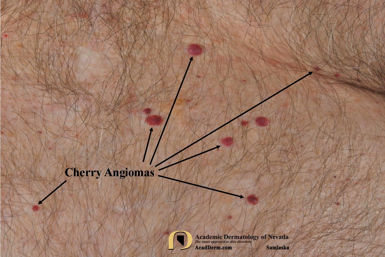 Cherry Angioma Senile Angioma... Academic Dermatology of Nevada