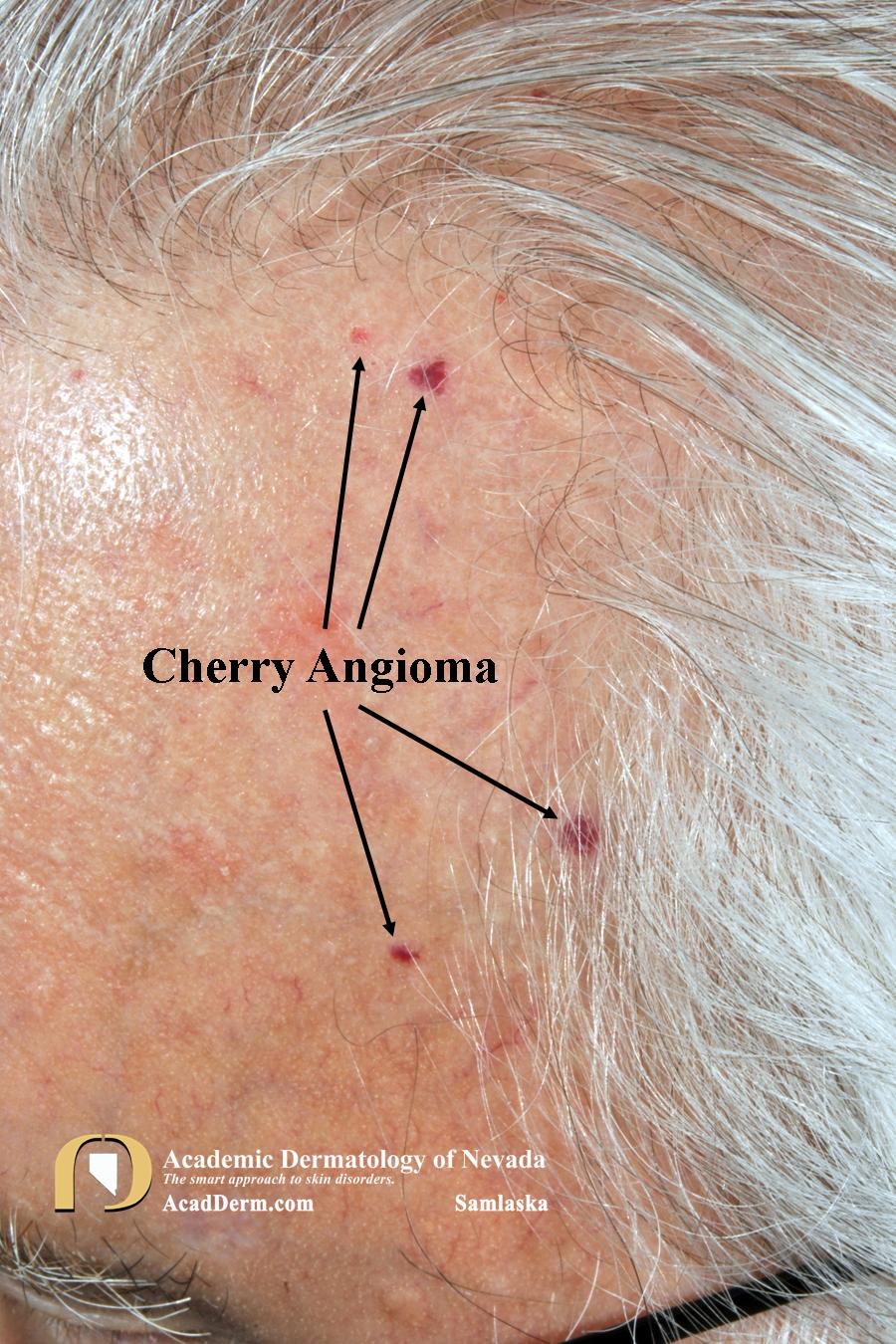 CherryAngioma5Samlaska Academic Dermatology of Nevada