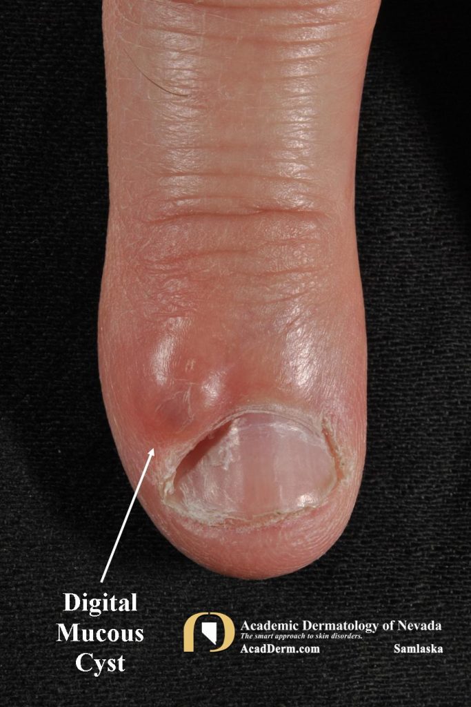 Digital Mucous Cyst (DMC) Myxoid Cyst... Academic Dermatology of Nevada