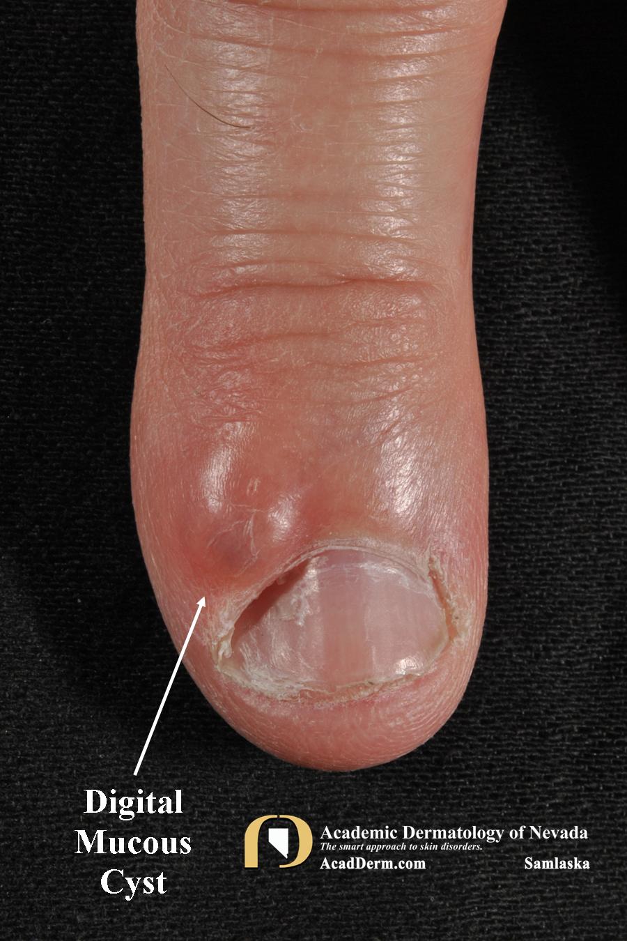 Digital Mucous Cyst (DMC) Myxoid Cyst... Academic Dermatology of Nevada