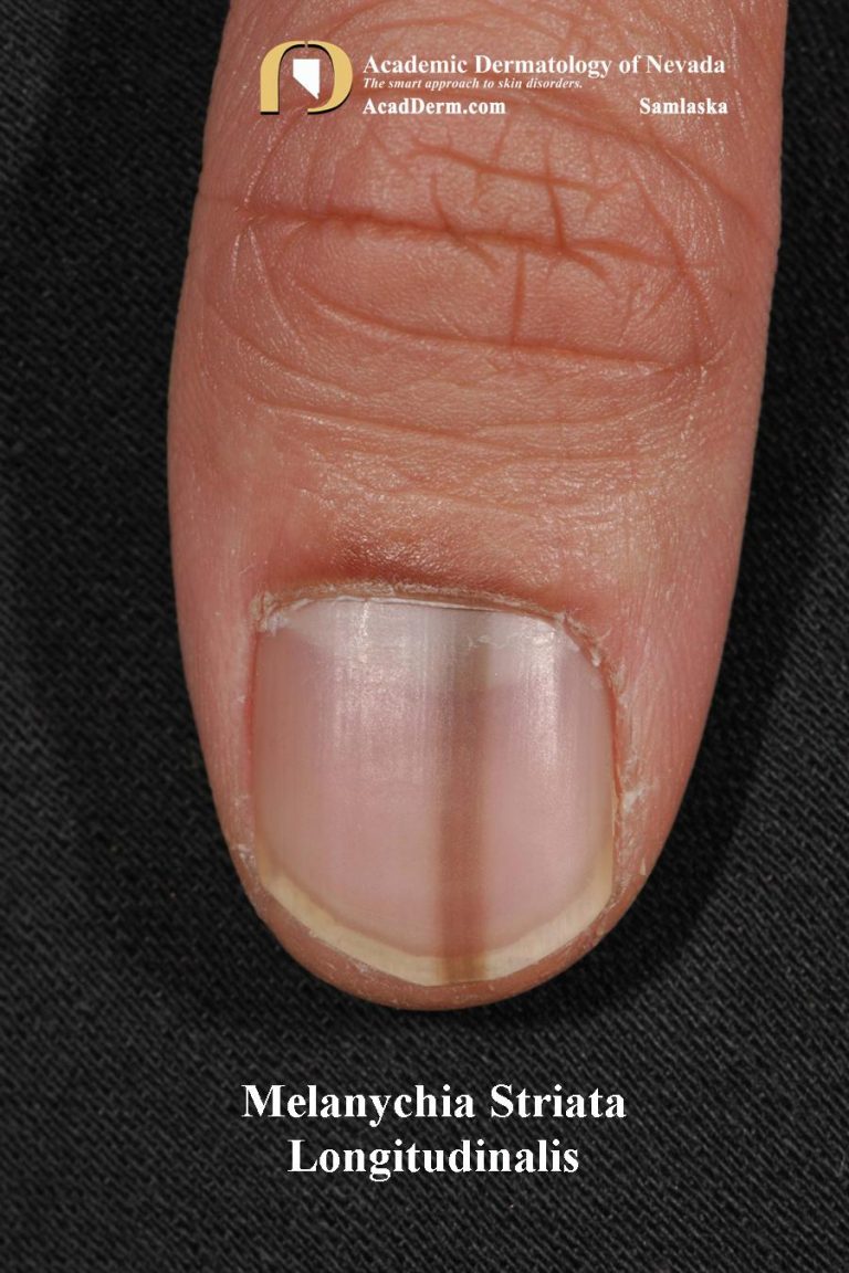 Melanonychia Striata Longitudinalis (MSL) Pigmented bands