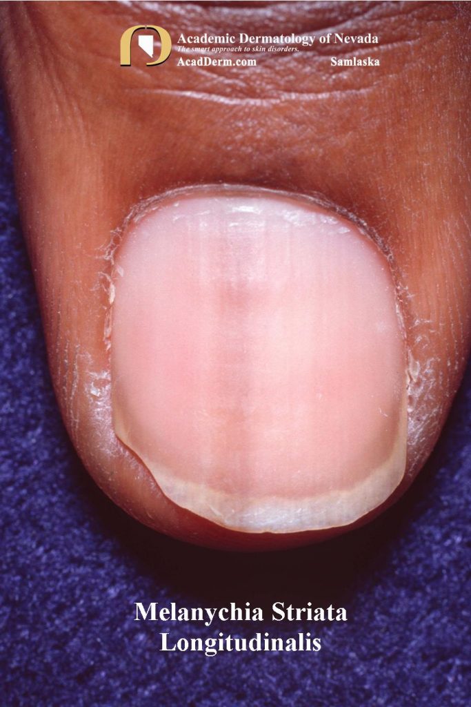 Melanonychia Striata Longitudinalis (MSL) Pigmented bands