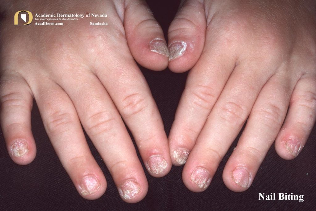 Nail Trauma Washboard Nails, Nail Biting... Academic Dermatology of