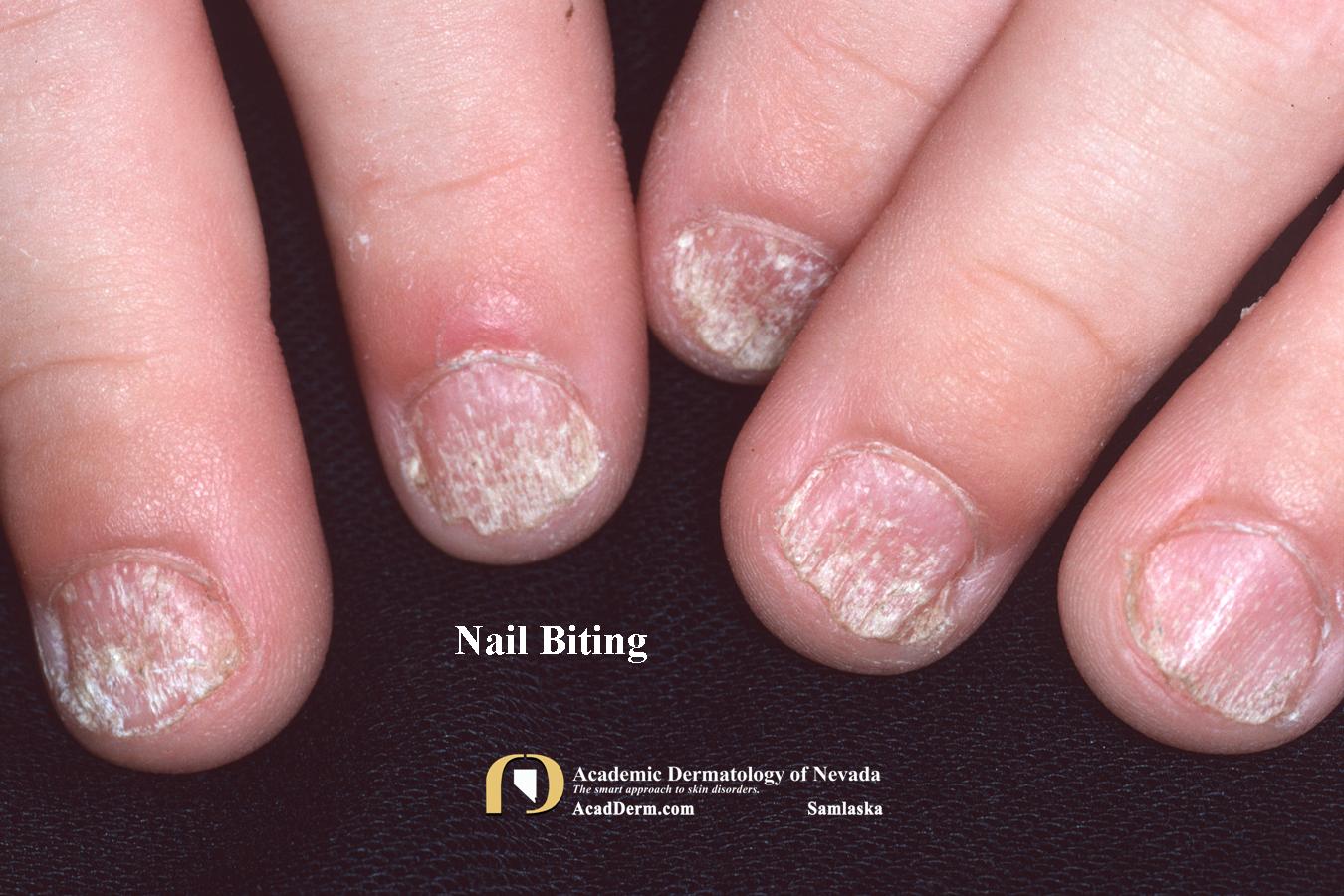 Nail Trauma Washboard Nails, Nail Biting... Academic Dermatology of