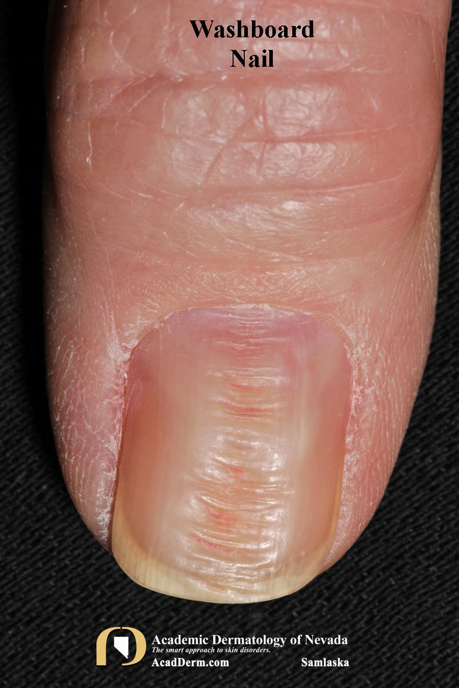 Nail Trauma Washboard Nails, Nail Biting... Academic Dermatology of