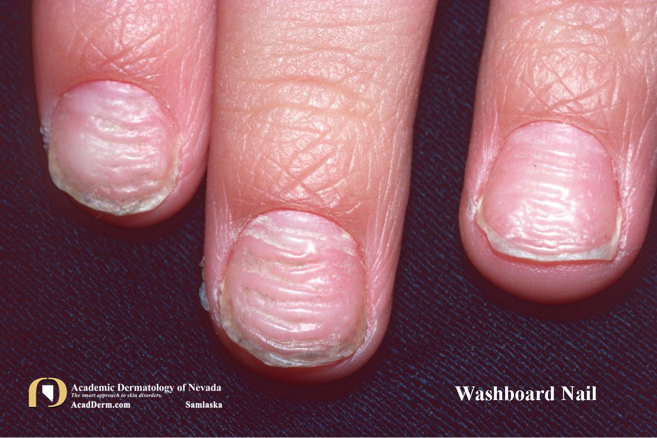 Nail Trauma Washboard Nails, Nail Biting... Academic Dermatology of