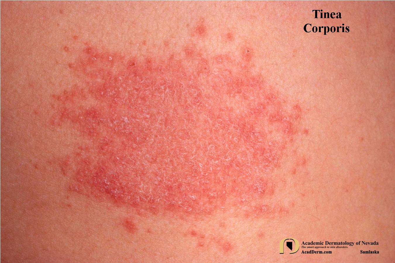 Tinea Corporis Ringworm, Tinea Circinata... Academic Dermatology of