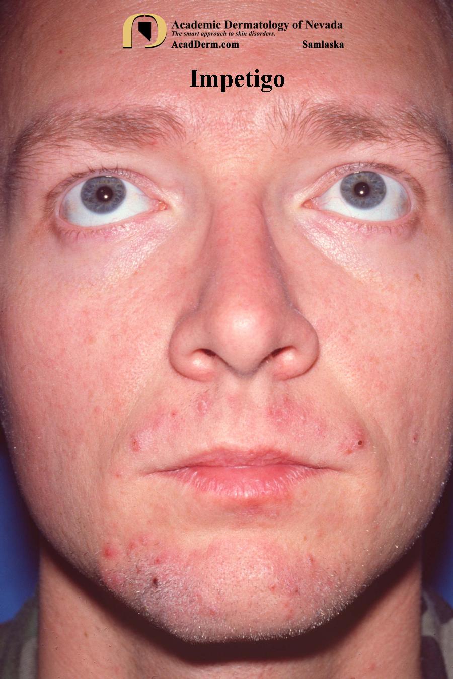 Impetigo Impetigo Contagiosa... Academic Dermatology of Nevada