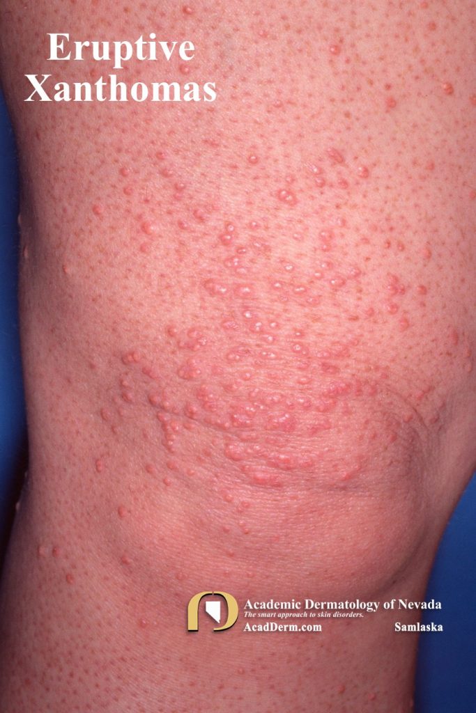 Xanthomas Signs of Dyslipidemia... Academic Dermatology of Nevada