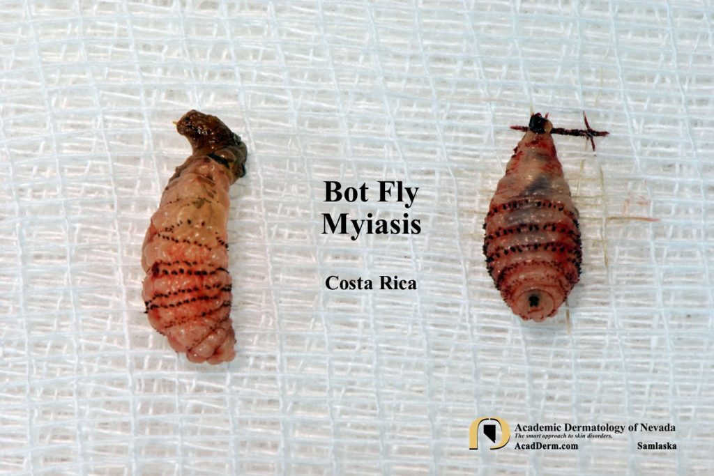 Bot Fly Myiasis What's eating me... Academic Dermatology of Nevada