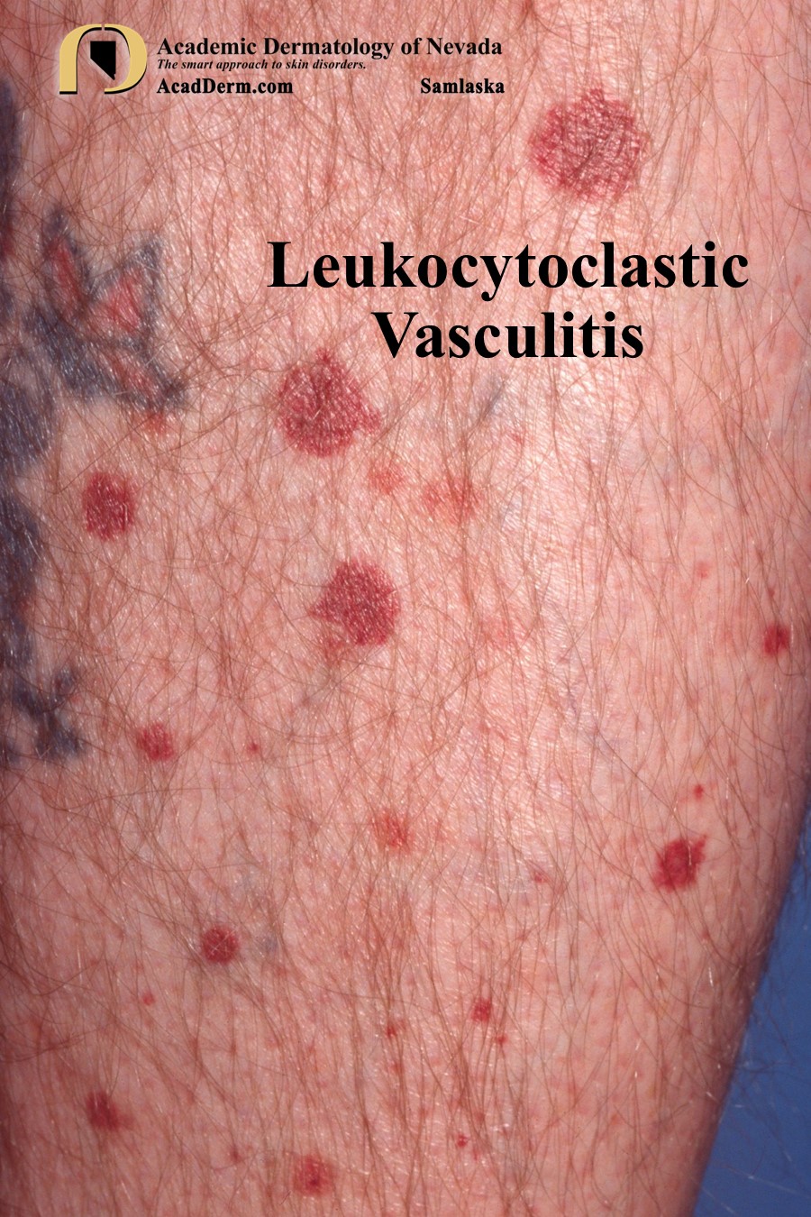 Leukocytoclastic Vasculitis SmallVessel Vasculitis... Academic Dermatology of Nevada