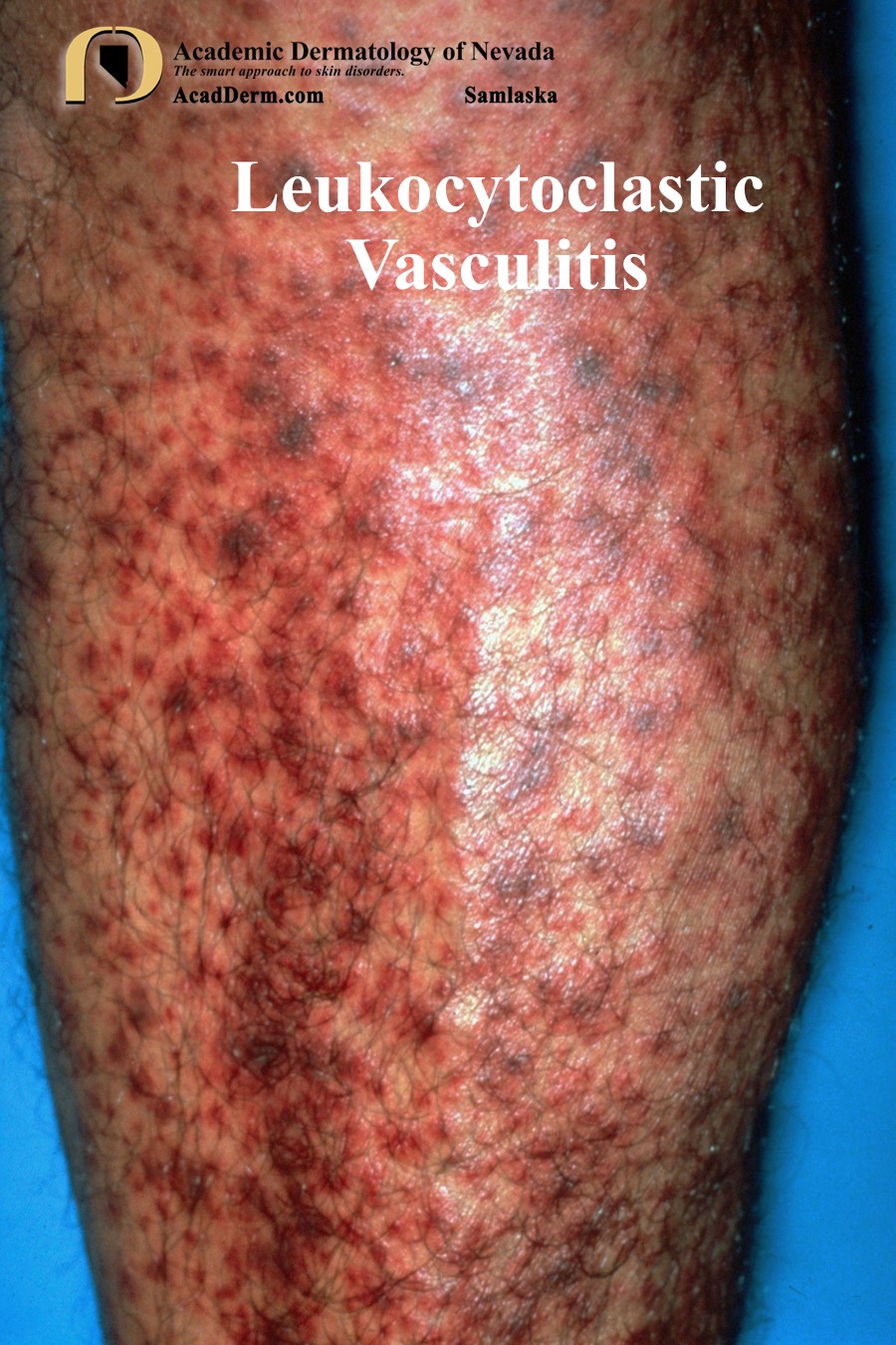 Leukocytoclastic Vasculitis SmallVessel Vasculitis... Academic