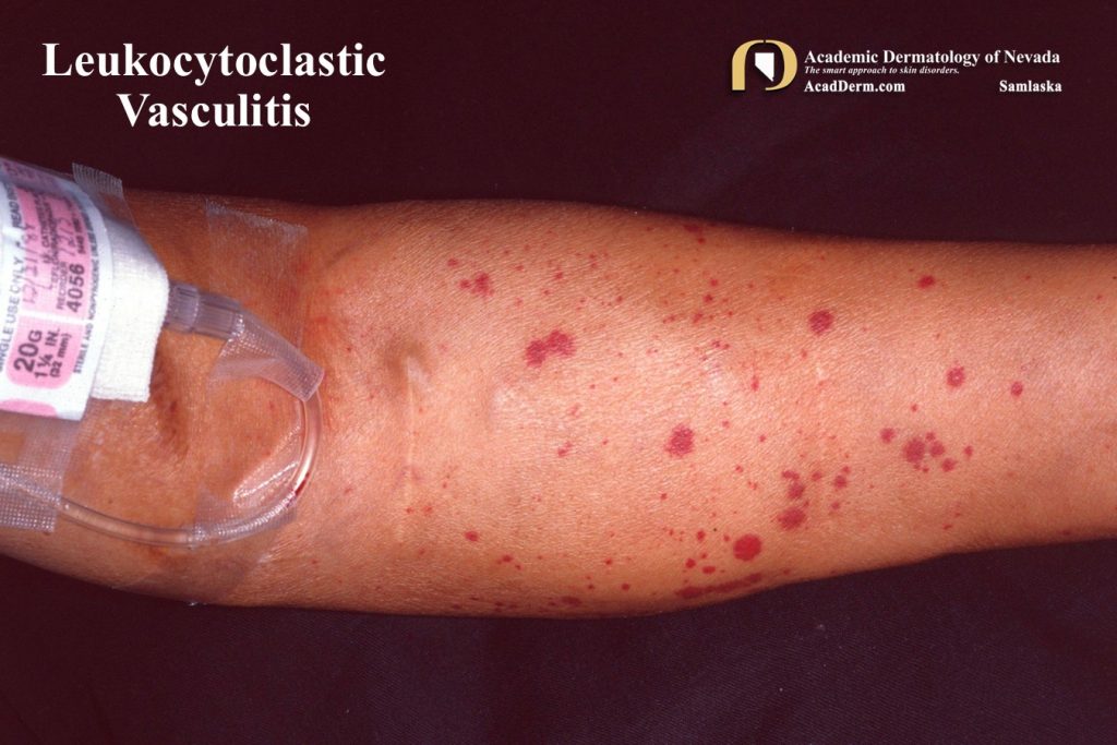 Leukocytoclastic Vasculitis SmallVessel Vasculitis... Academic