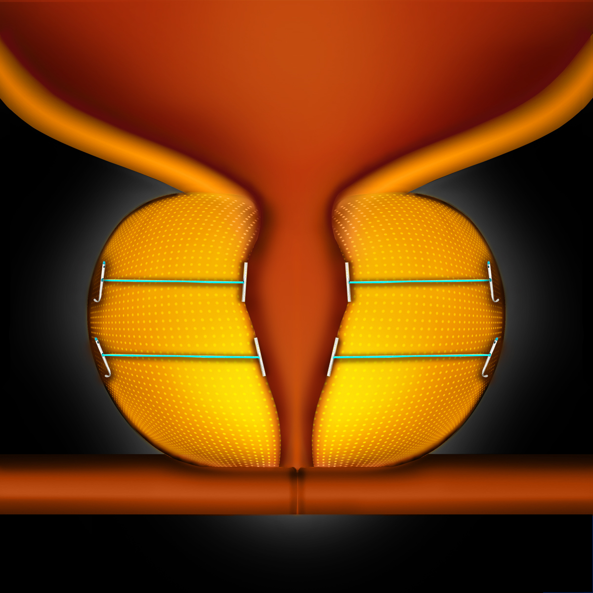 Prostate UroLift System Minimally Invasive BPH Treatment