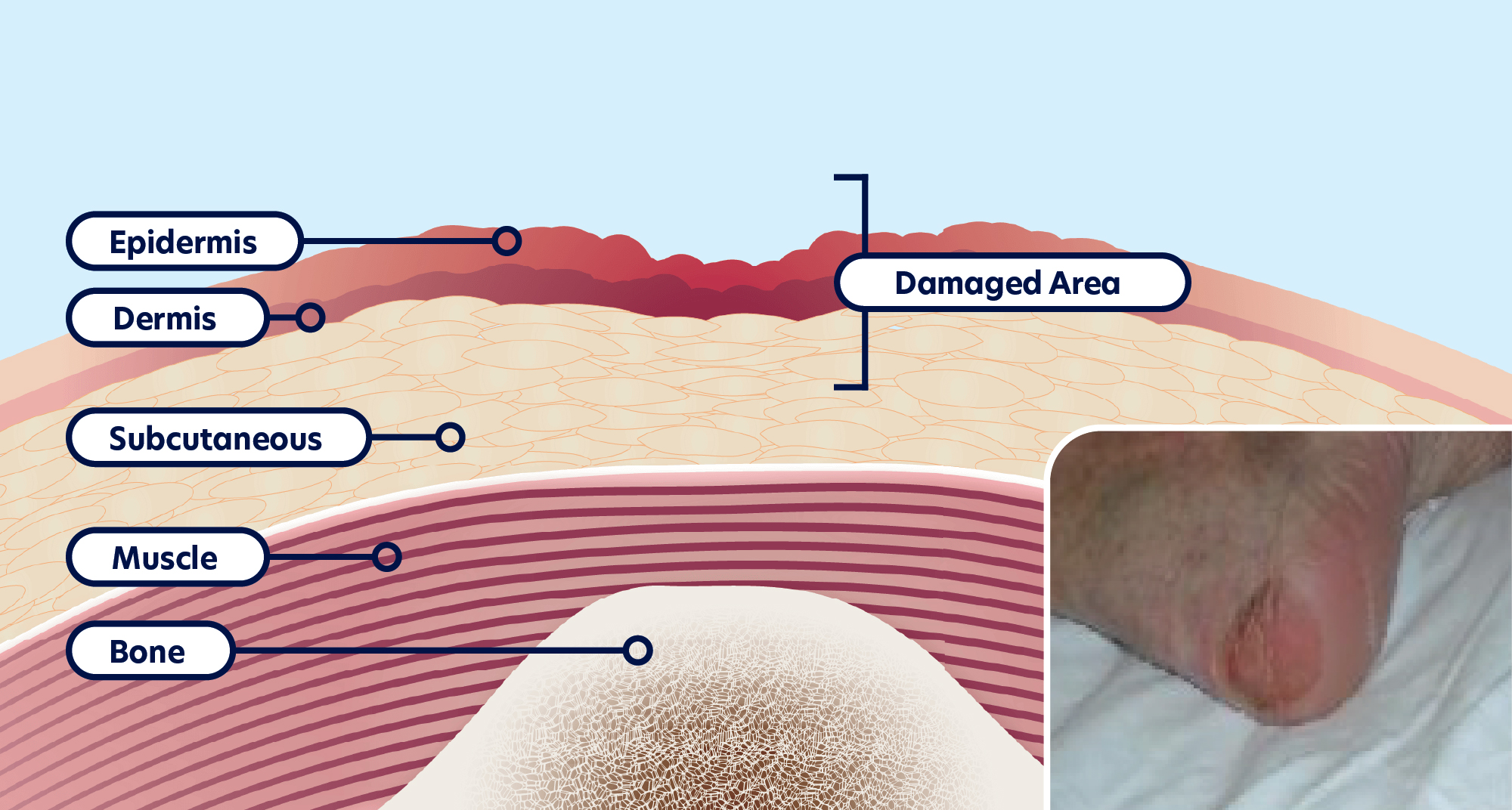 EPUAP Pressure Ulcer Classification 2019 Part 1 ActivHeal® Academy