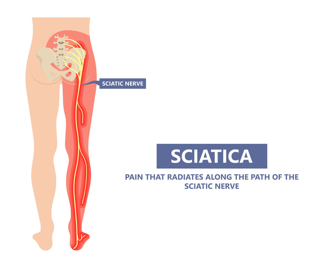 Sciatica and What you need to know ACC