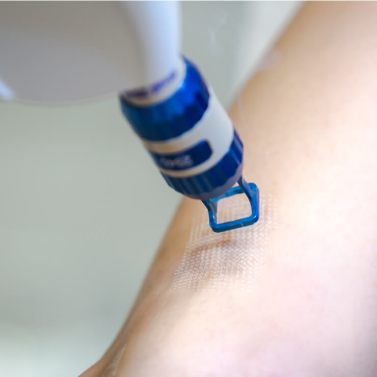 Spider Vein Treatment San Francisco Laser Vein Ablation Bay Area