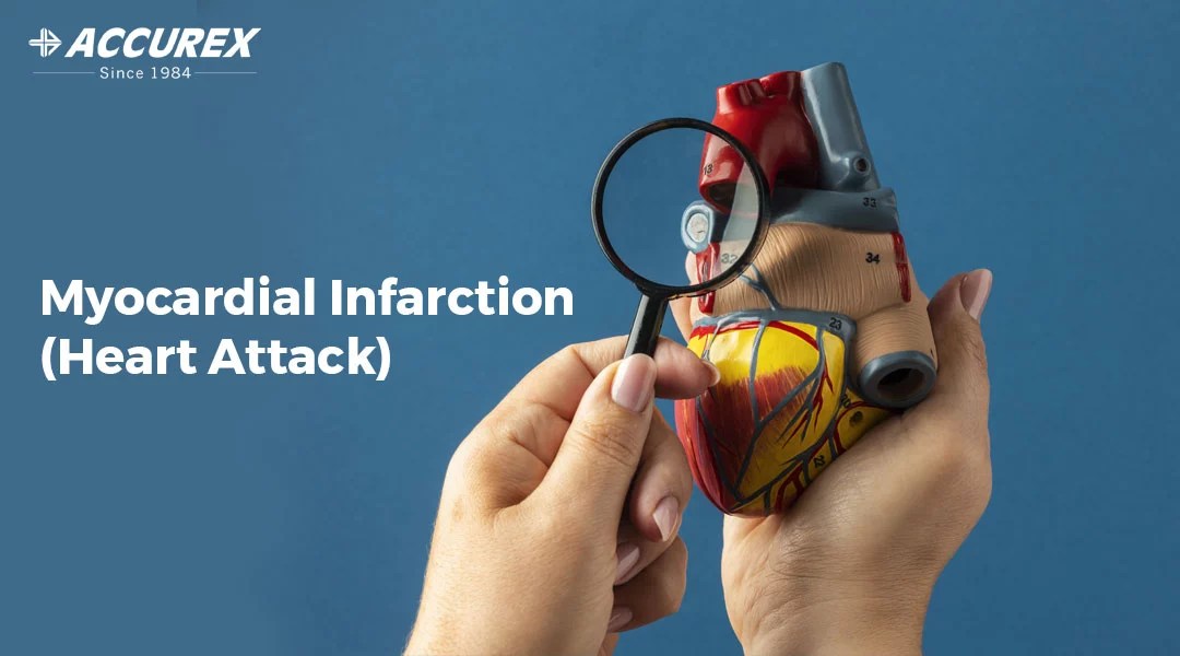 Myocardial Infarction Causes Symptoms Diagnosis & Treatment