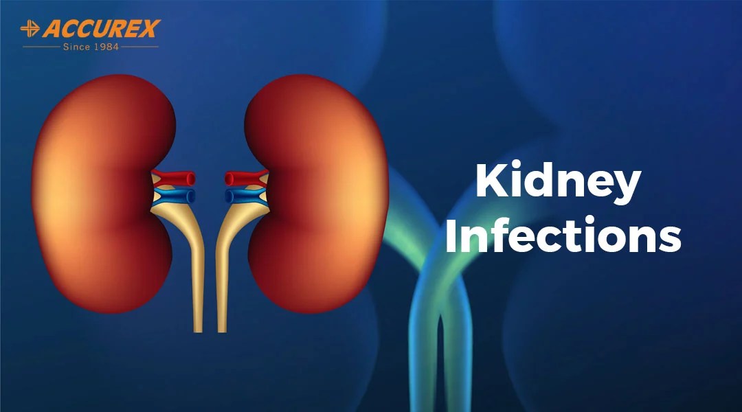 Kidney Infections Symptoms, Causes, Diagnosis & Treatment