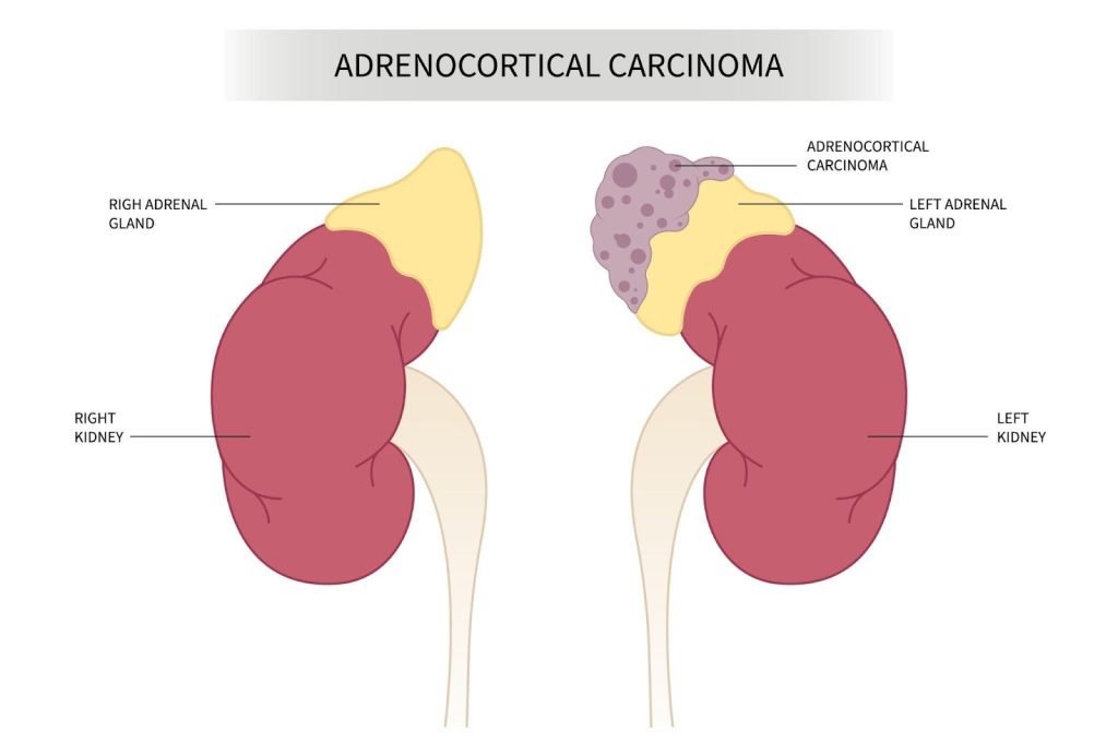 Adrenal Cancer Treatment Singapore Endocrine Specialist Clinic