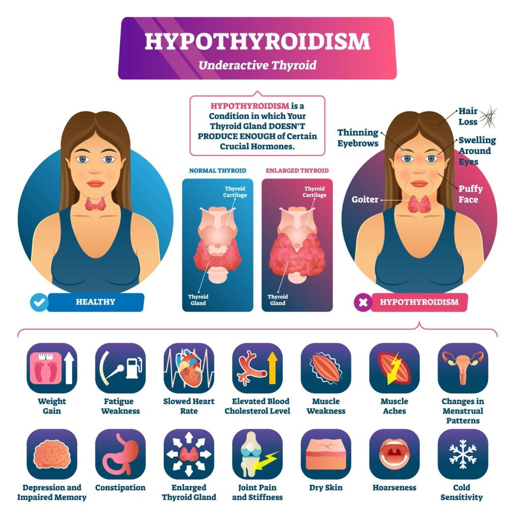 Hypothyroidism (Underactive Thyroid) Ace Specialist Surgery & Endoscopy