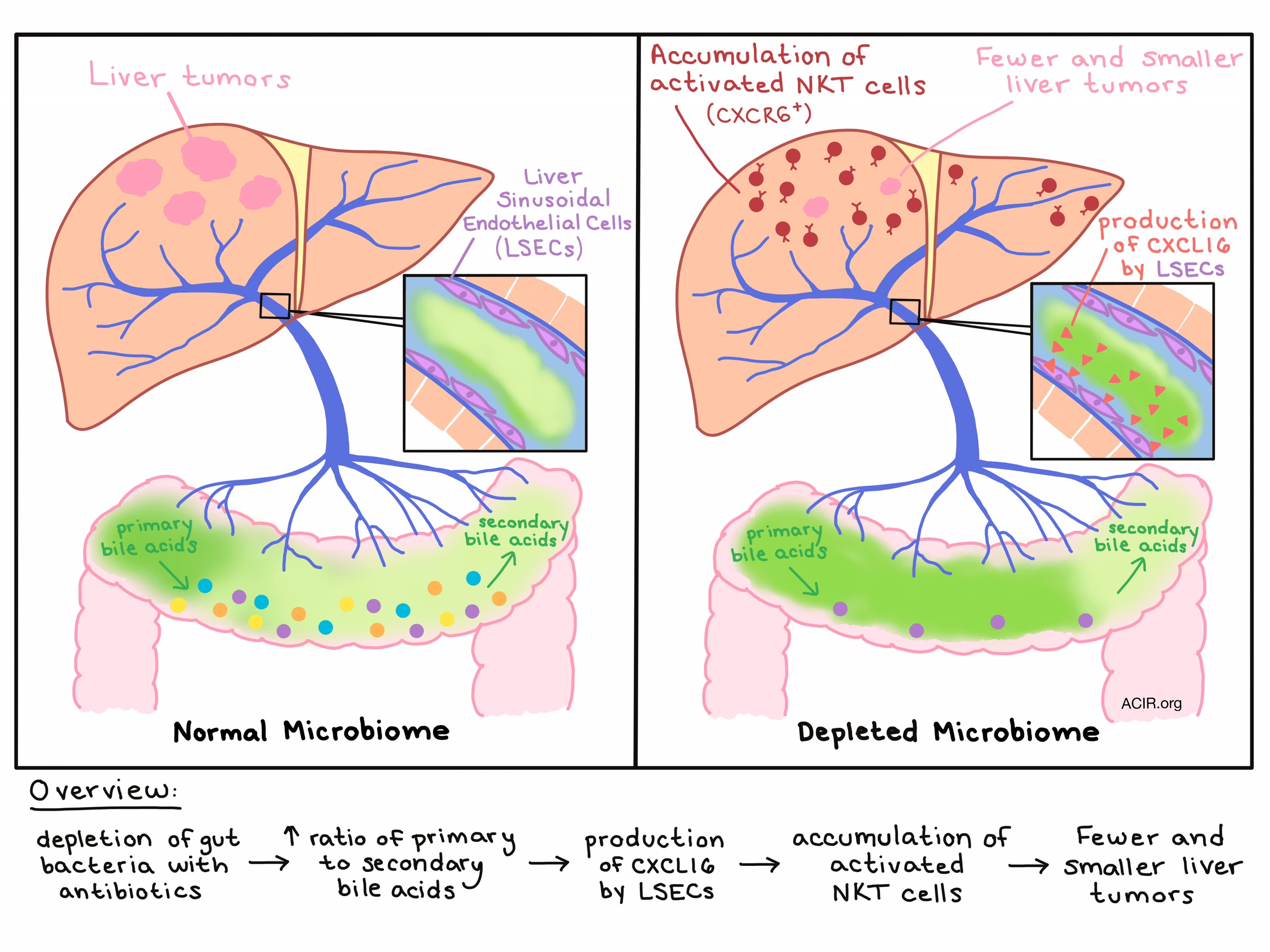 Liver cancer, immunity, and the microbiome connecting the dots