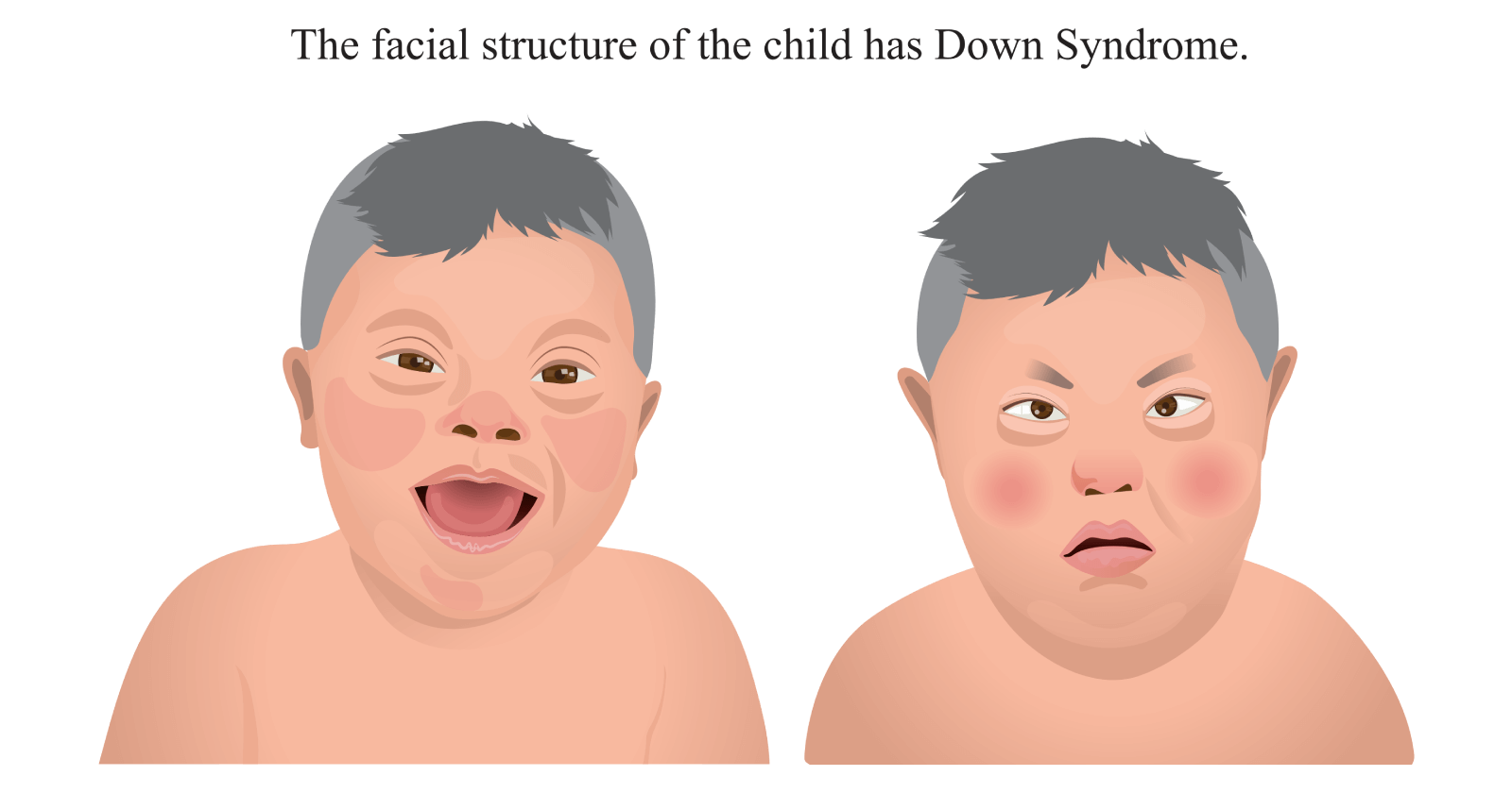 Down Syndrome: Symptoms, Causes, Prevention and Treatments