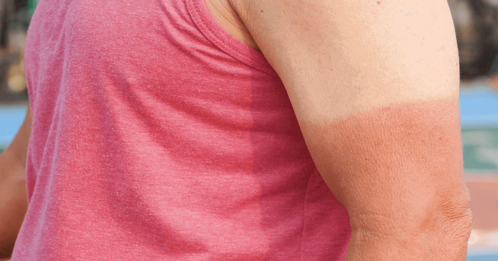 First Aid for Sunburn Meaning, Symptoms, Causes & Treatments