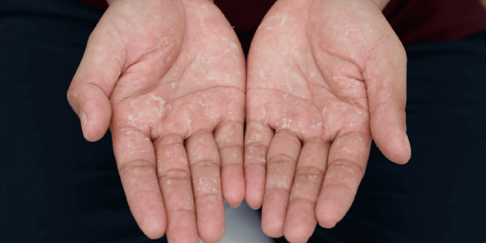 Dyshidrotic Eczema (Dyshidrosis) Overview,Symptoms, causes, and treatment