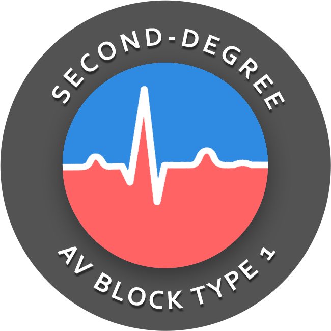 Second degree AV block