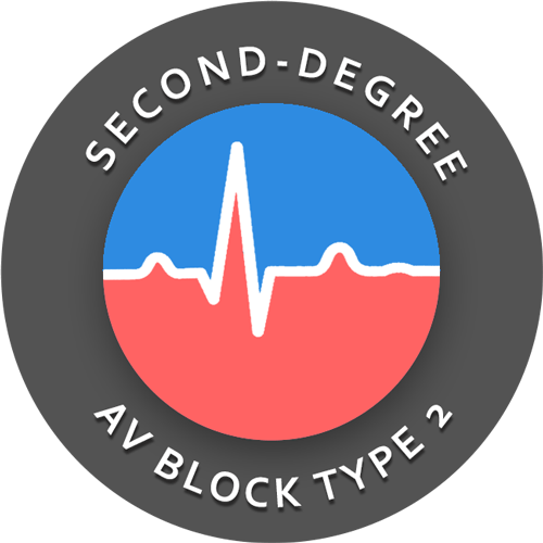 Second degree AV block type 2