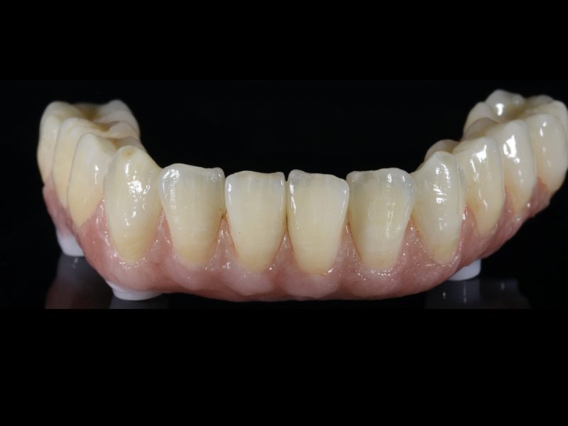 PFM Implant Retained Prosthesis Acme Dental Lab