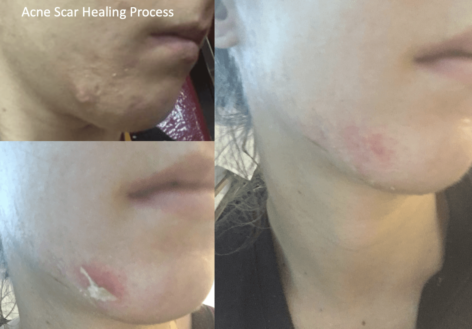 Acne Scar Community & Treatment