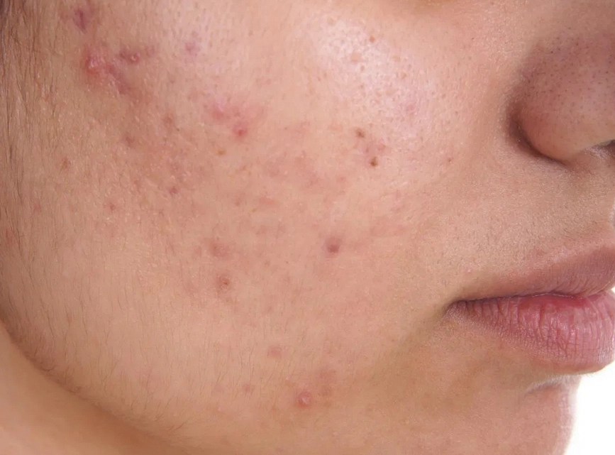 8 Proven Treatments for Severe Acne (Benzoyl Peroxide, Tretinoin