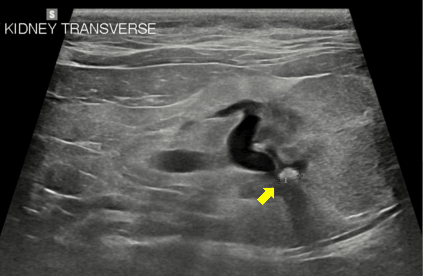5pBA4 A noninvasive ultrasound device to treat urinary stones in pet