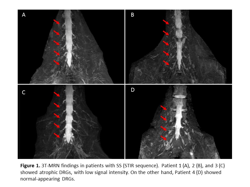 Detection of Dorsal Root Ganglionitis with Resonance