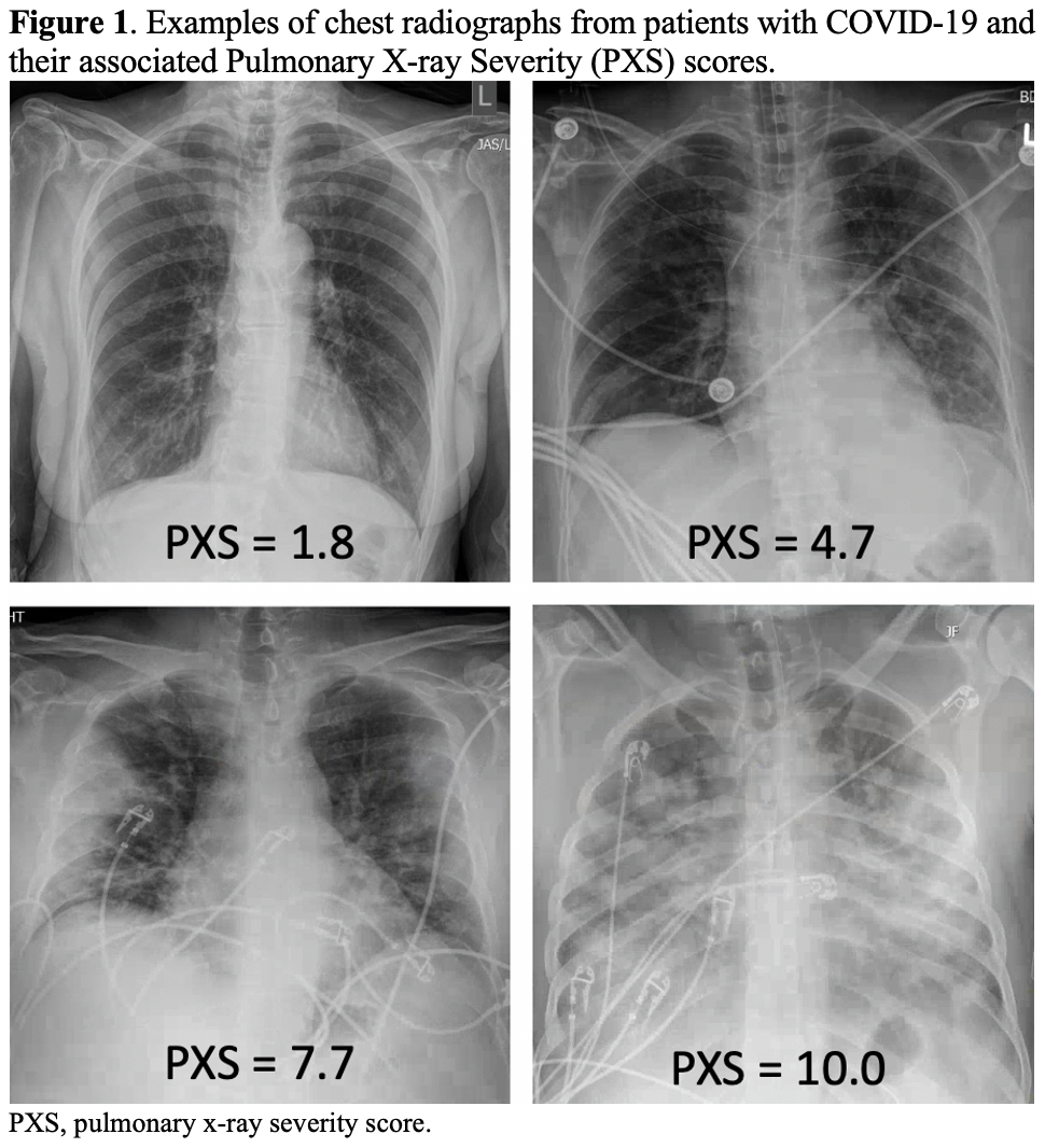 Deep LearningDerived Chest Radiograph Scores in COVID19 in Rheumatic