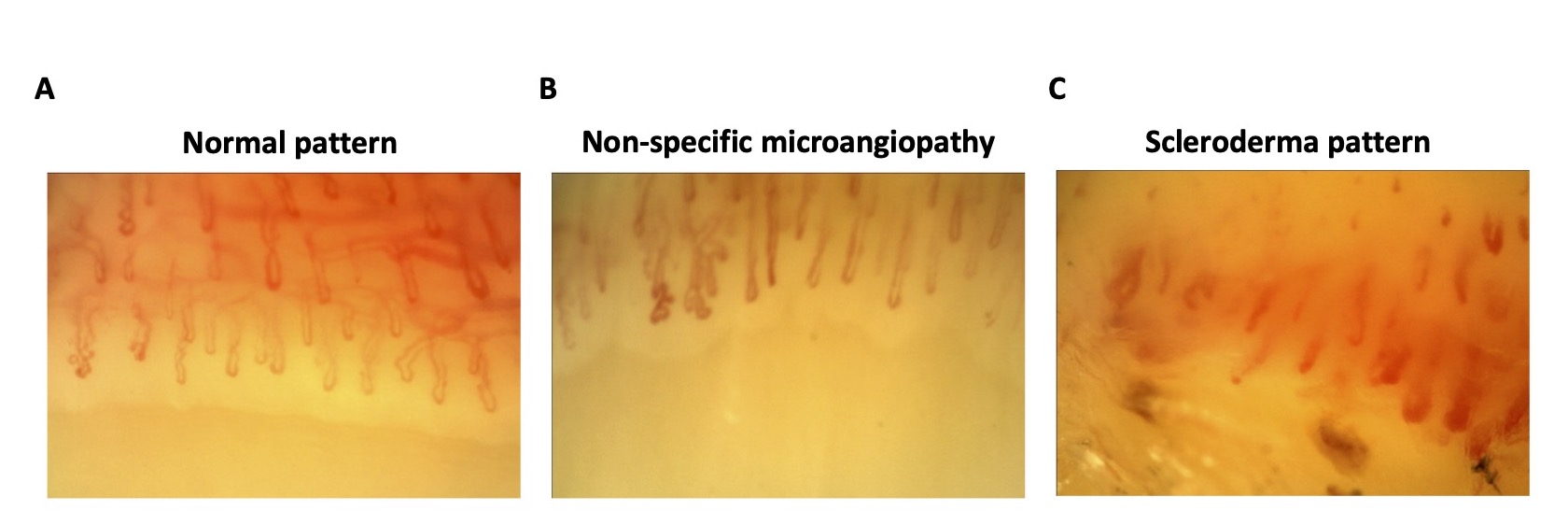 Nailfold Videocapillaroscopy Findings and Associations with Organ
